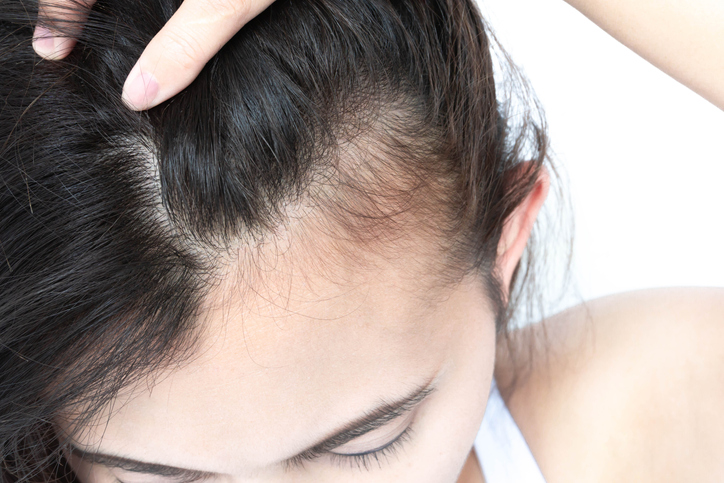 Woman holding back hair to reveal hair loss
