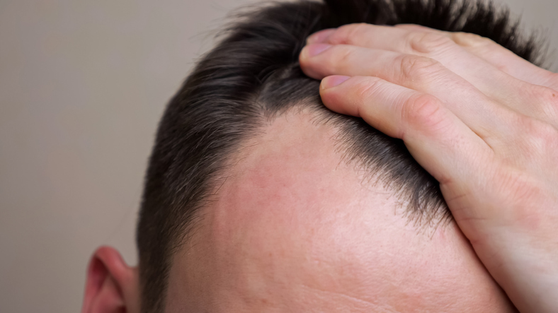 Young man examines his bald spots